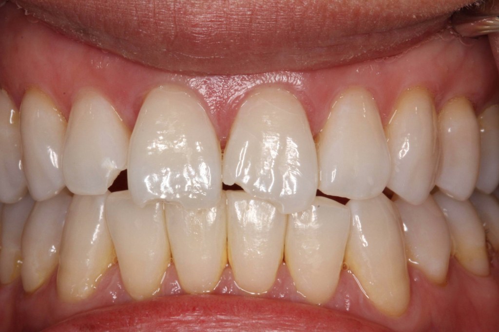 Composite Build Up